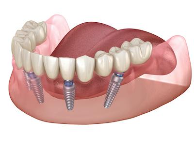 diagram of dental implants in tuscaloosa, al