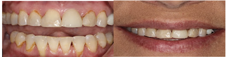 dental crowns before & after | dental crowns tuscaloosa