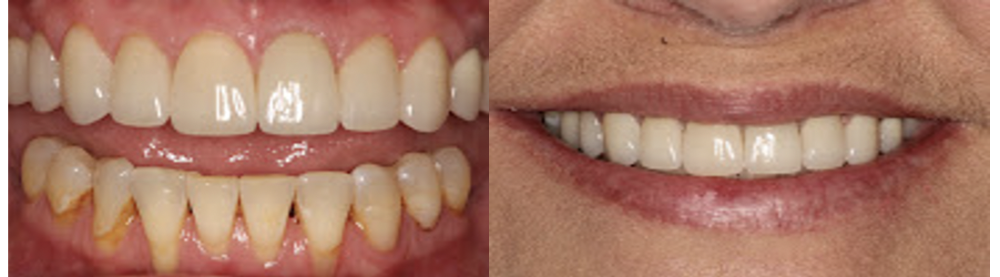 before and after dental crowns | dentist tuscaloosa al