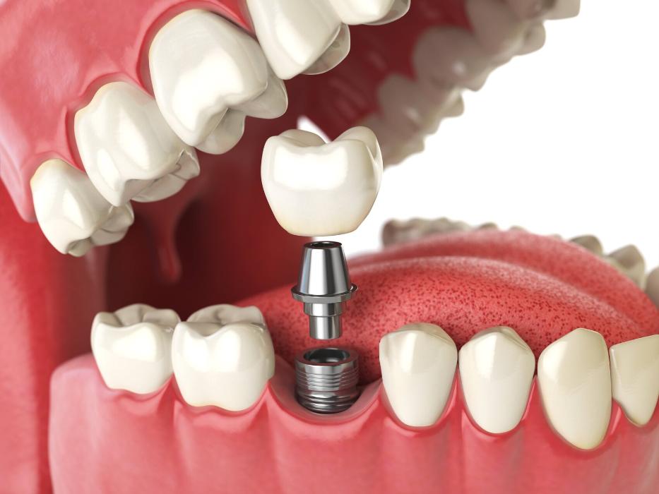 tooth implant from a tuscaloosa dentist