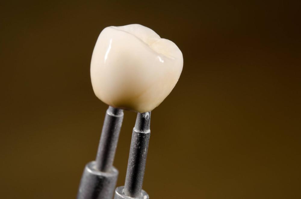 tooth crown from a tuscaloosa dentist