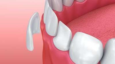 Image of porcelain veneers, tuscaloosa al