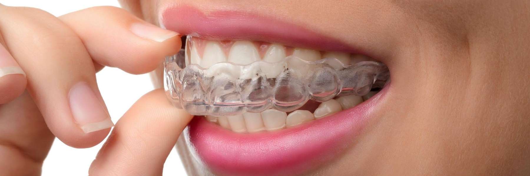 Invisalign aligner tray going into teeth, tuscaloosa al