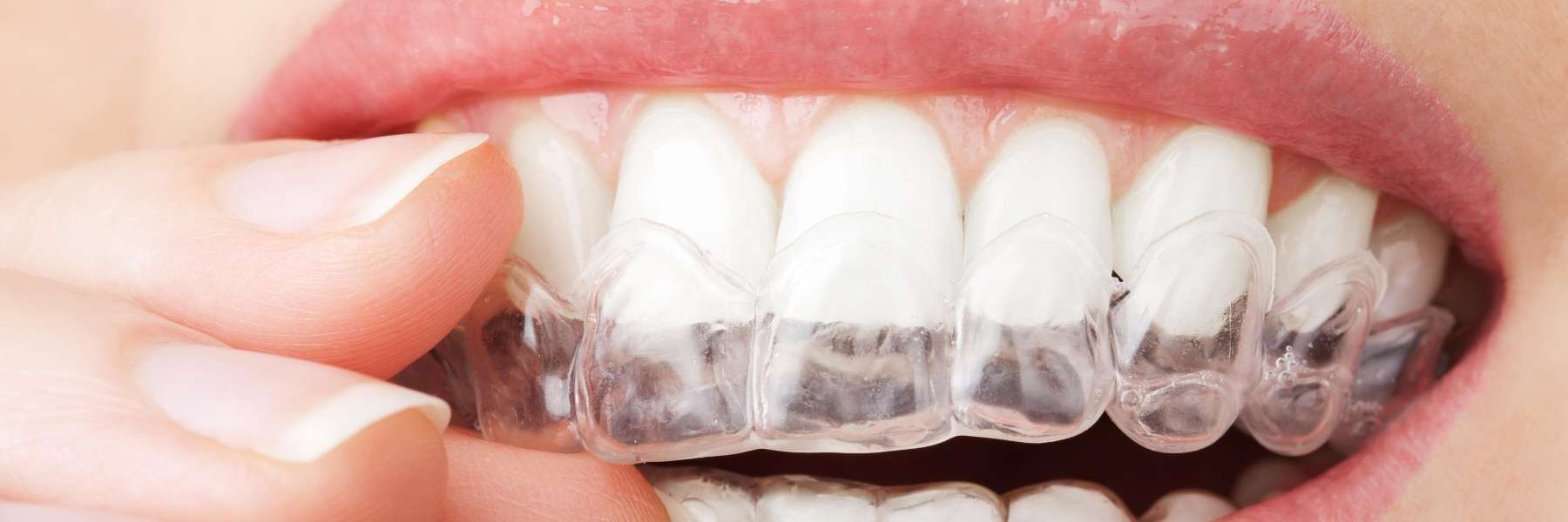 Close up of mouth with clear aligners, tuscaloosa al