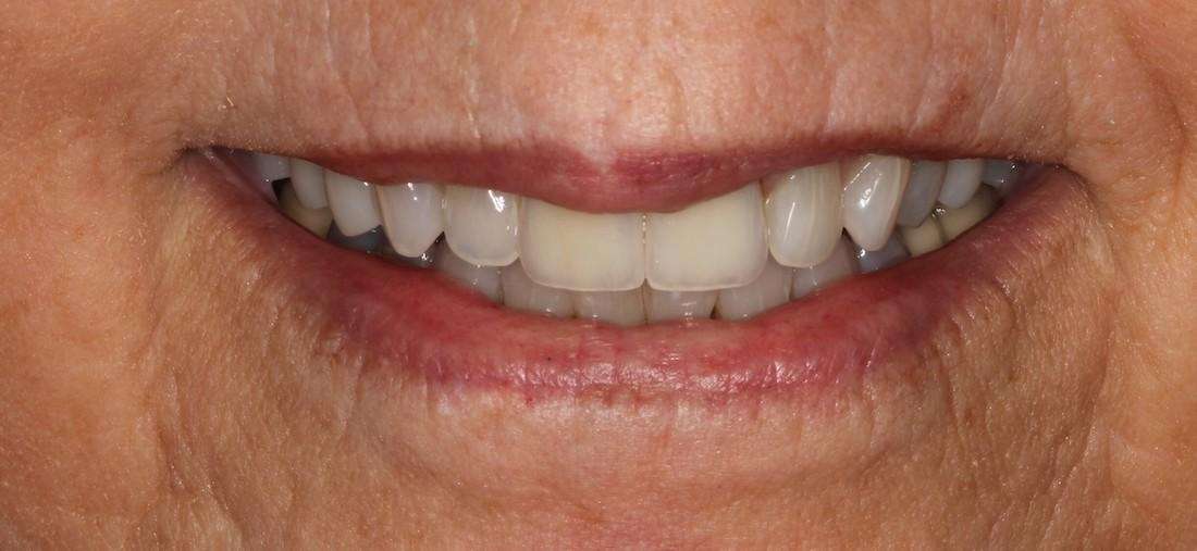 crowns used to create a more uniform look on front teeth