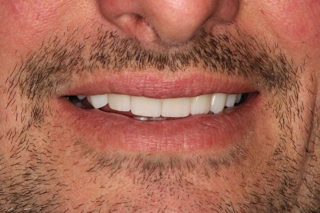 porcelain crown used to correct chipped front tooth