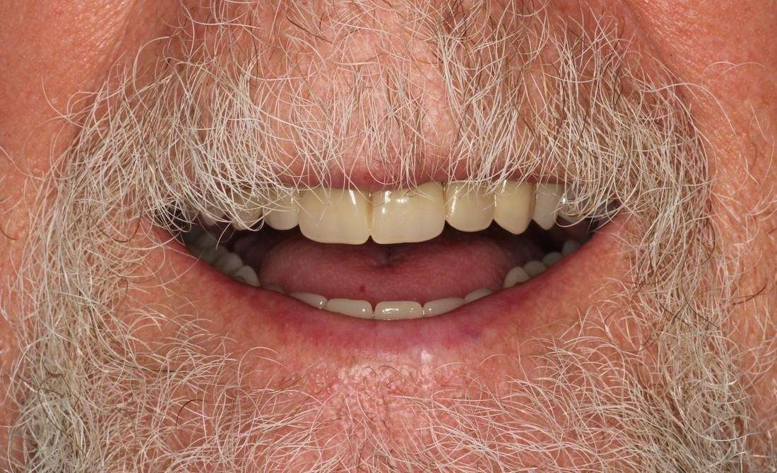 man's decayed teeth replaced using dental implants