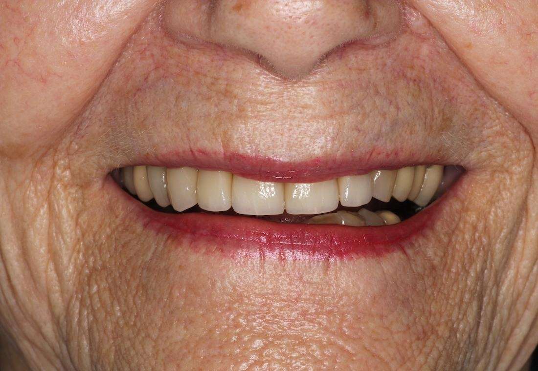 crown used to correct broken front tooth