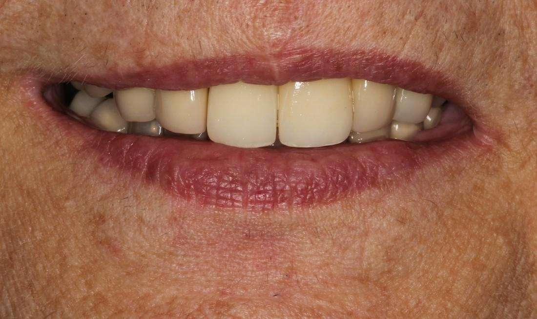 patient's new smile after using implants and crowns to replace missing teeth