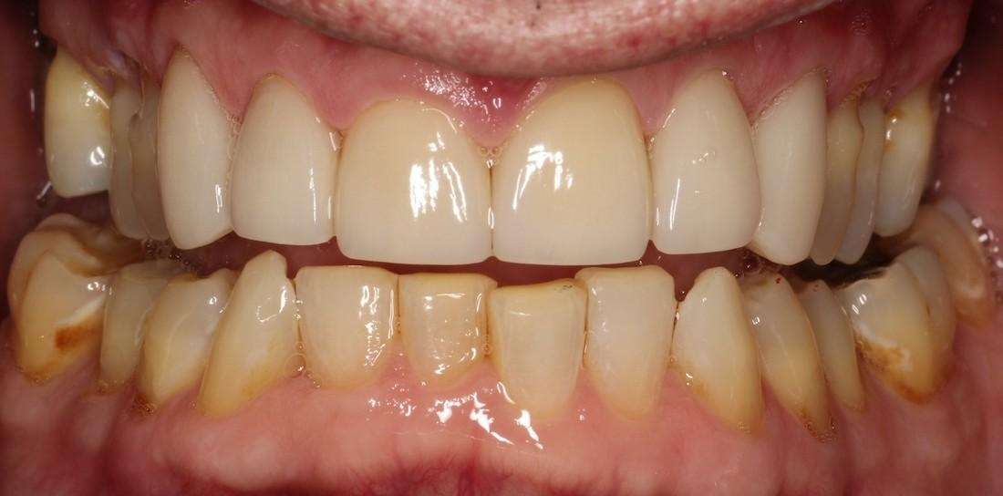 patient's smile after decayed teeth