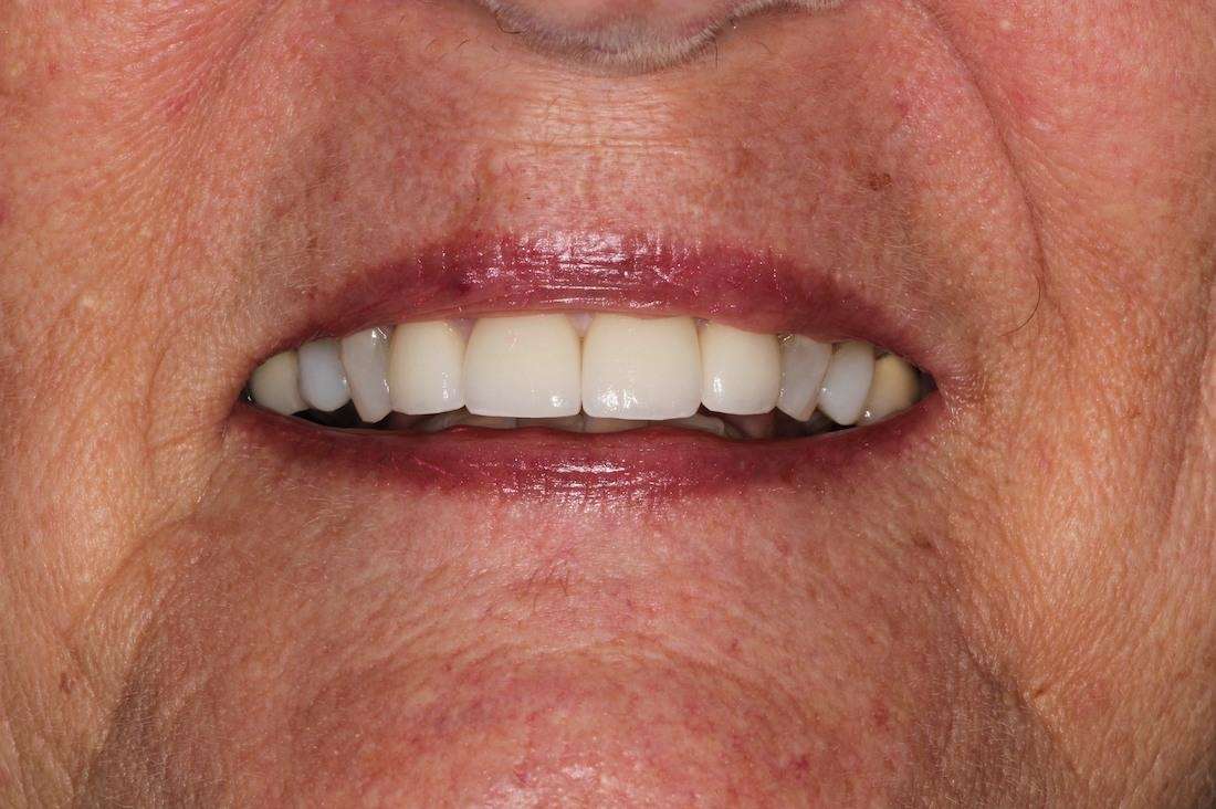 porcelain crowns used to transform this patient's misshapen front teeth