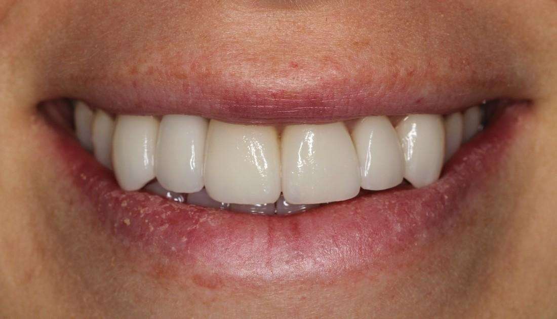 porcelain veneers and crowns used to reshape this patient's front teeth