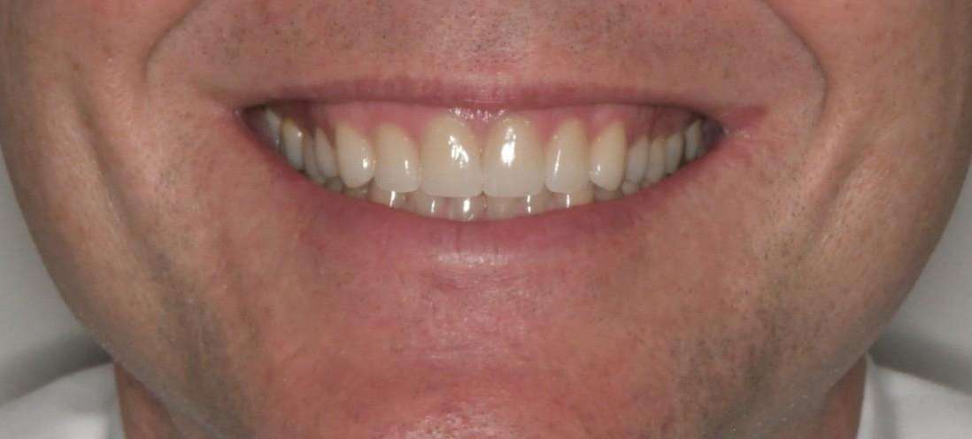 man's new smile after crowns and veneers, tuscaloosa al