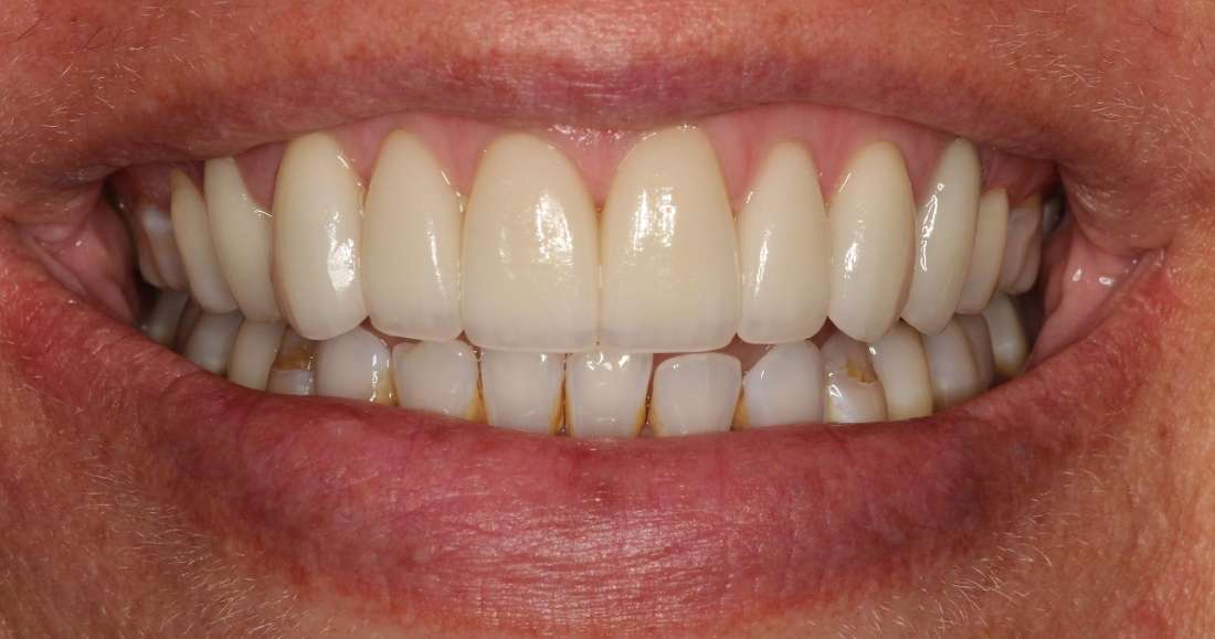 Mouth after porcelain veneers, tuscaloosa al