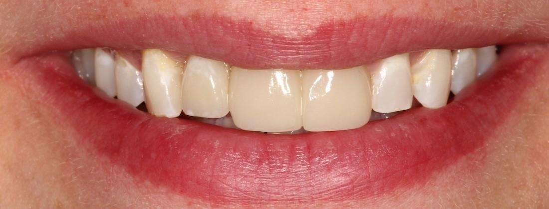 smile after using implants and crowns to fix broken teeth