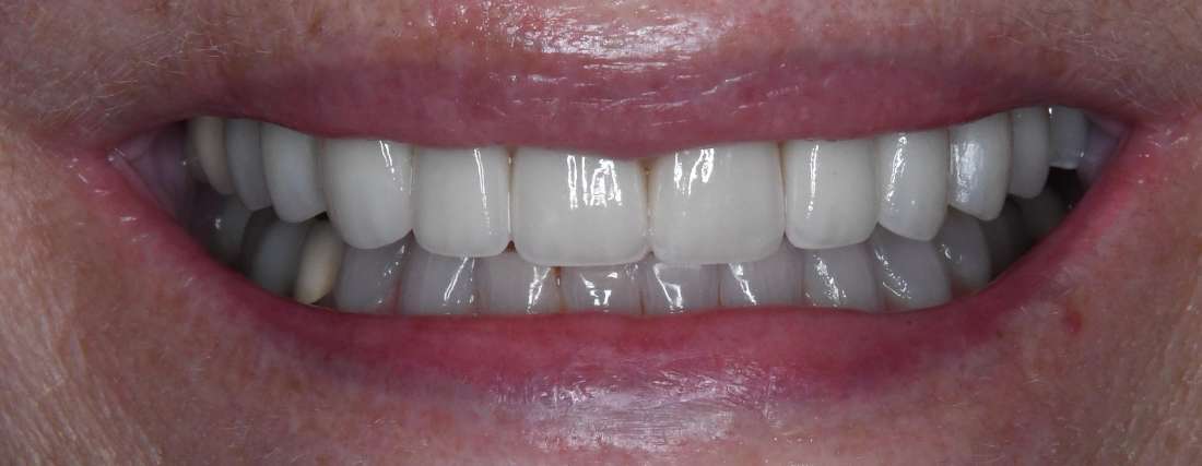 Close up of teeth after teeth whitening, tuscaloosa al