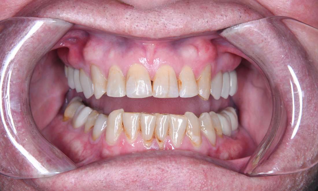 Close up of mouth after extensive dental work, tuscaloosa al