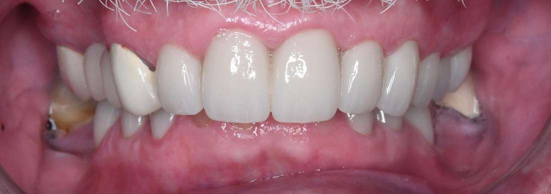 Close up of mans teeth with mustache after porcelain crowns, tuscaloosa al