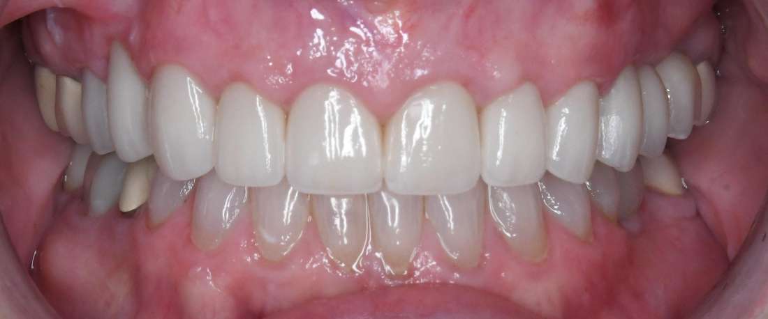 Close up of mouth after teeth whitening and crowns, tuscaloosa al