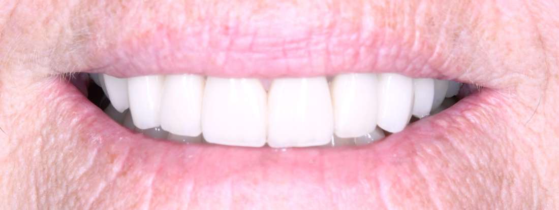 Mouth after Teeth Whitening, Porcelains Crowns, and Porcelain Bridge, tuscaloosa al