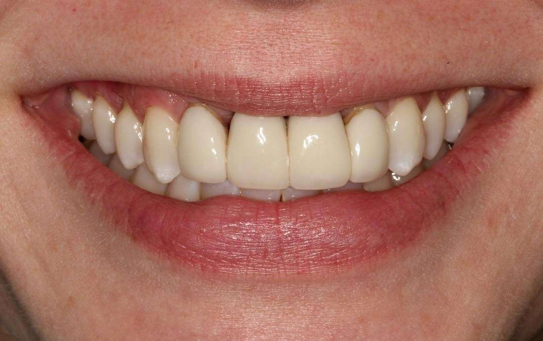 old dental crowns