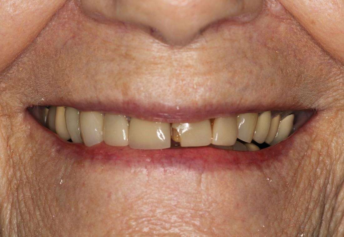 close up of older woman's smile with broken front teeth