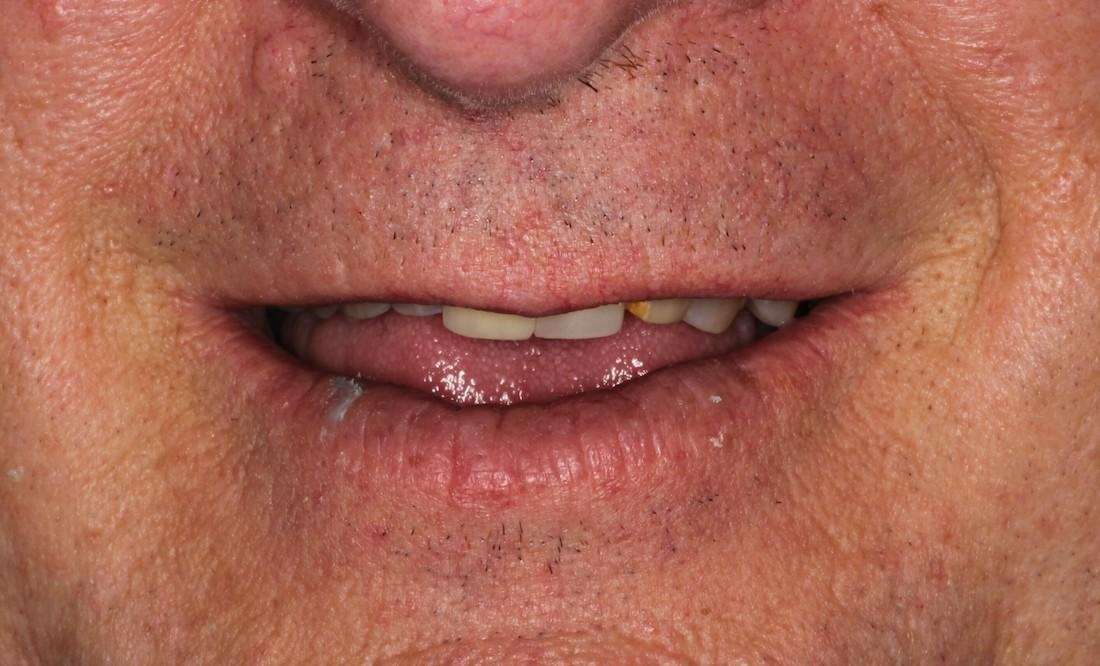 missing and compromised front teeth