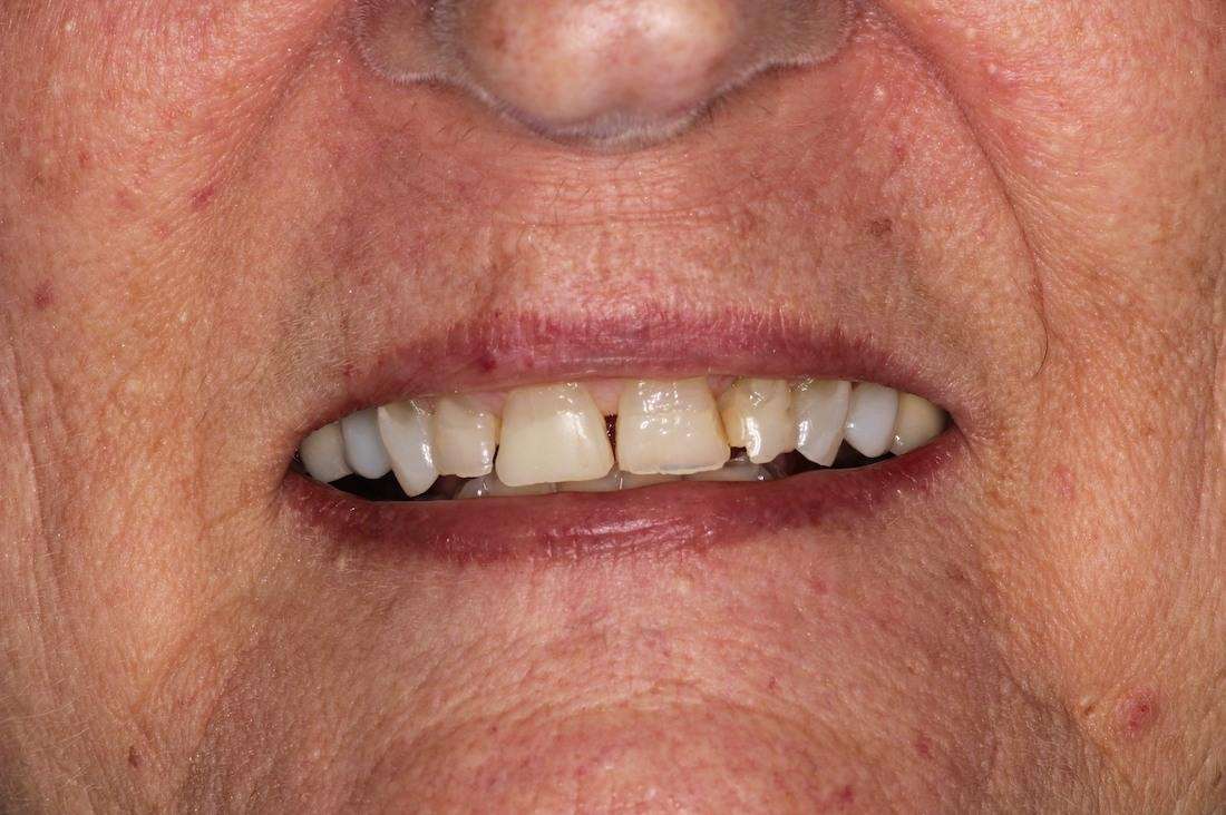 misshapen front teeth of patient