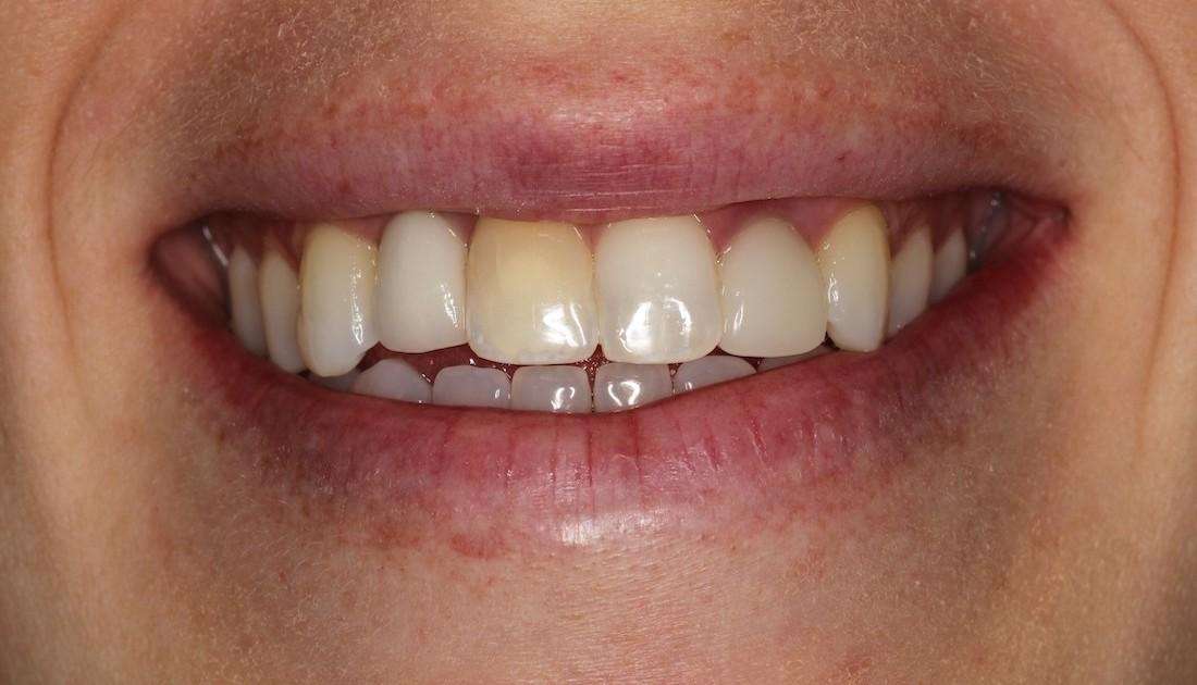 close up of patient's smile