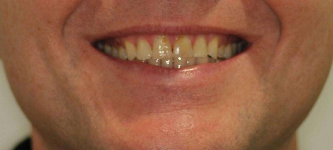 close up of man's smile before crowns and veneers, tuscaloosa al