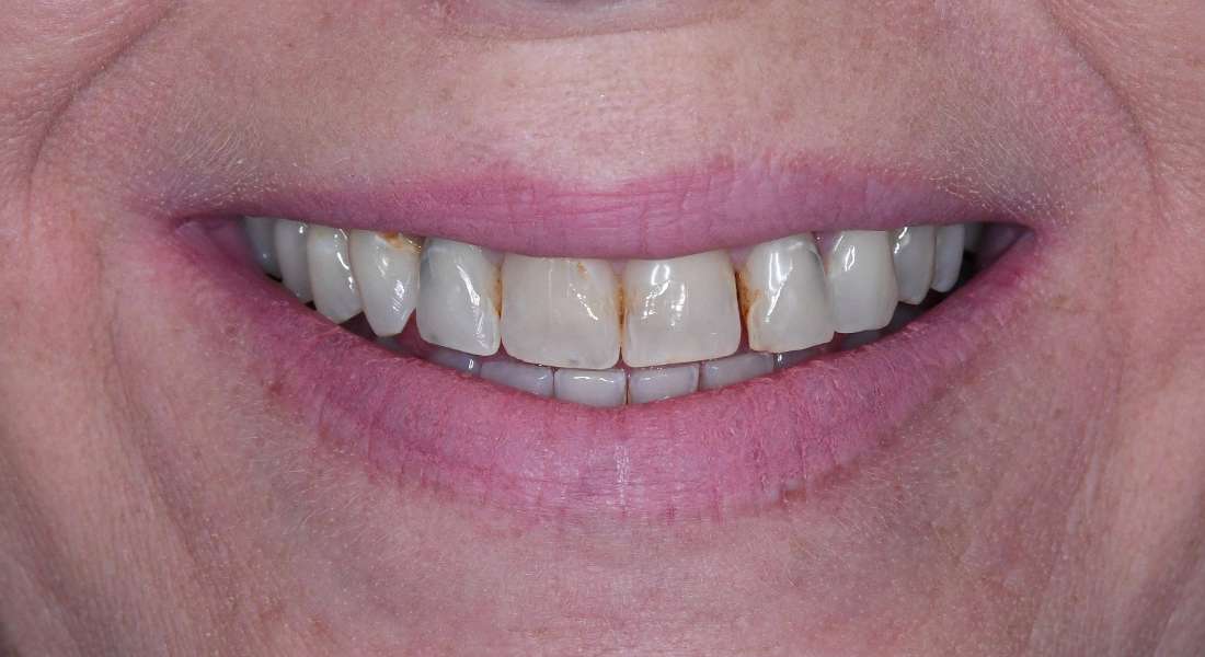 Womens mouth before porcelain crowns, tuscaloosa al