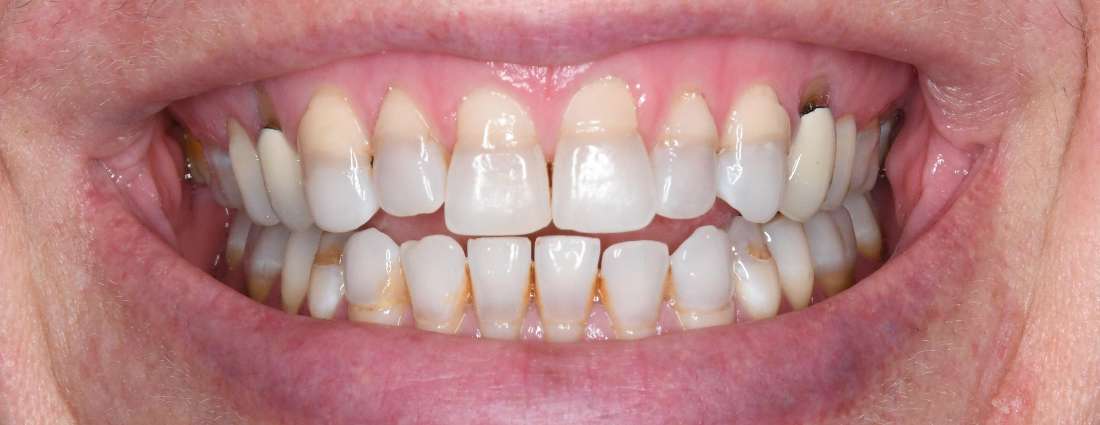 Mouth before porcelain veneers, tuscaloosa al