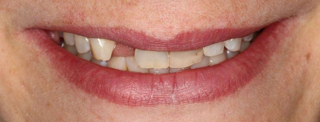 Smile with missing and broken teeth