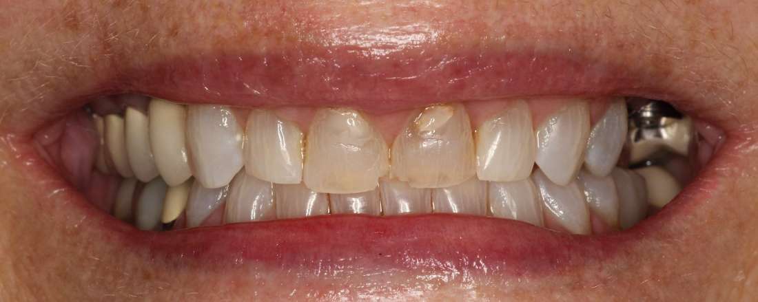 Close up of teeth before teeth whitening, tuscaloosa al