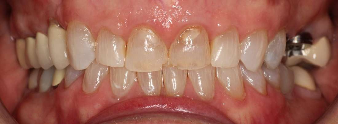 Close up of mouth before teeth whitening and crowns, tuscaloosa al