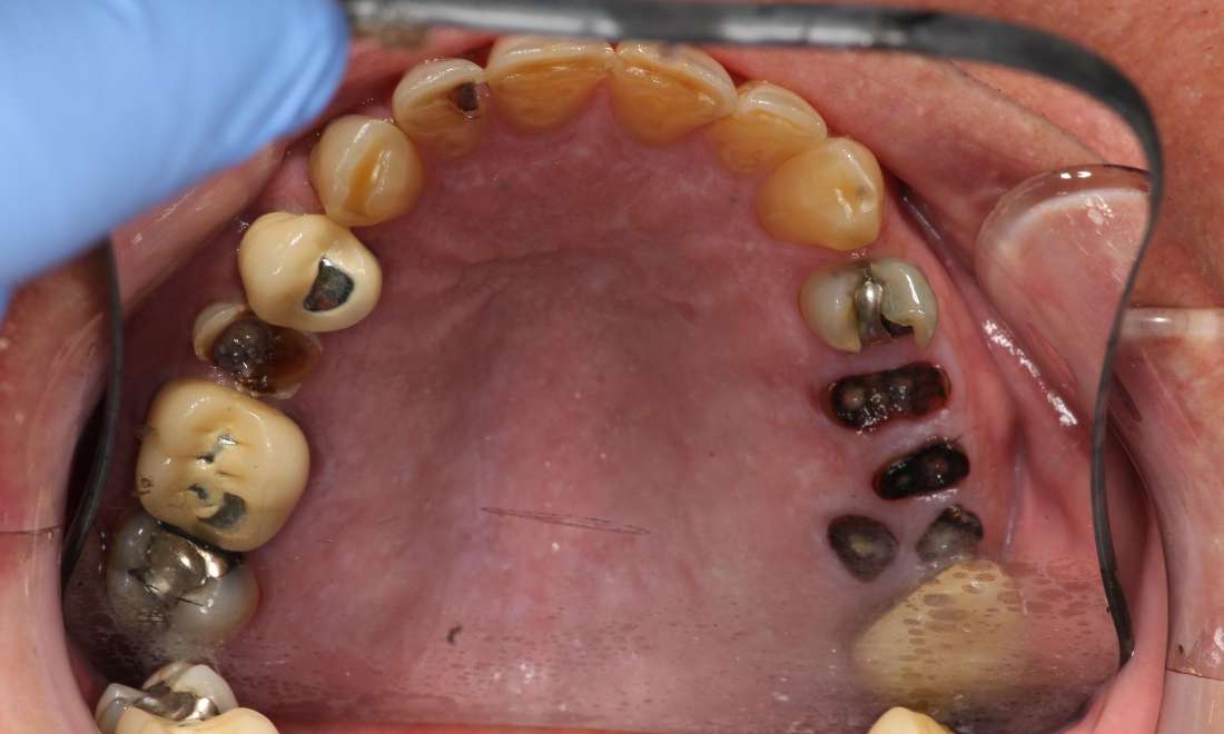 Overhead view of mouth before extensive dental work, tuscaloosa al
