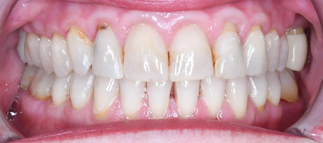 Close up of womens teeth before porcelain crowns, tuscaloosa al
