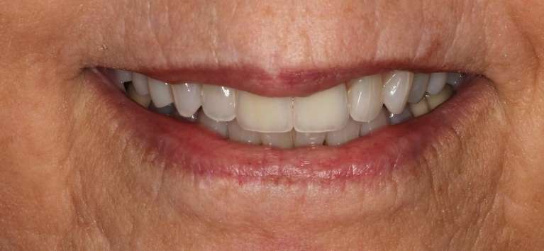 crowns used to create a more uniform look on front teeth