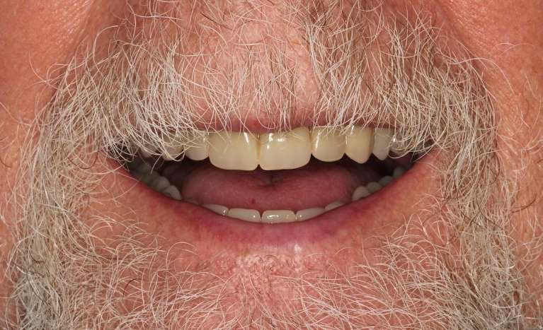 man's decayed teeth replaced using dental implants