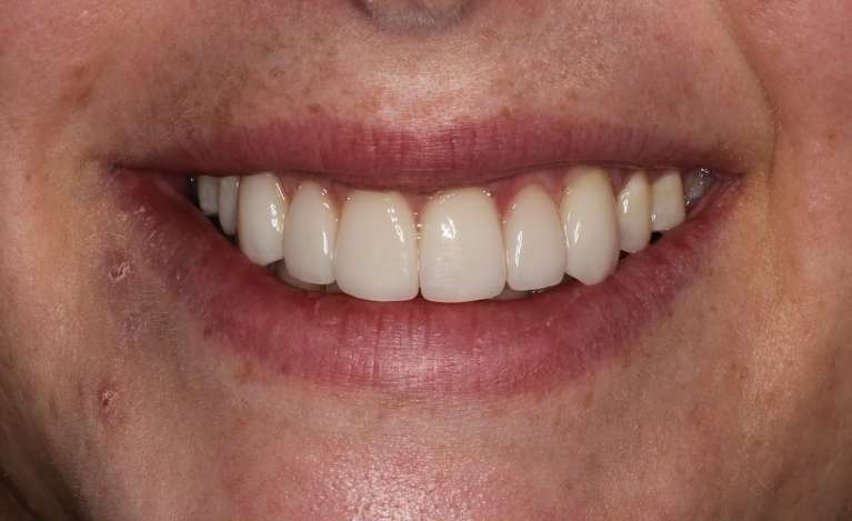 veneers used to transform discolored teeth