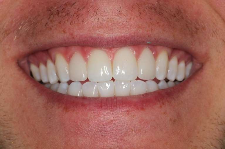 porcelain veneers used to improve front teeth