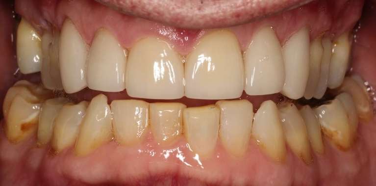 patient's smile after decayed teeth