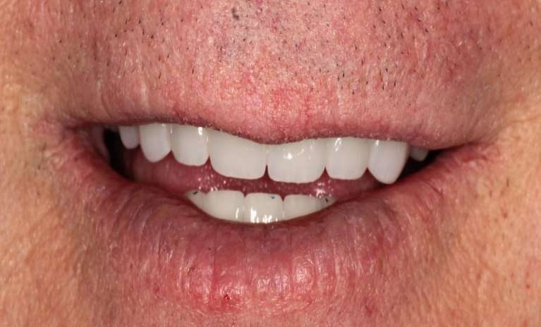 porcelain bridge used to replace this patient's front teeth