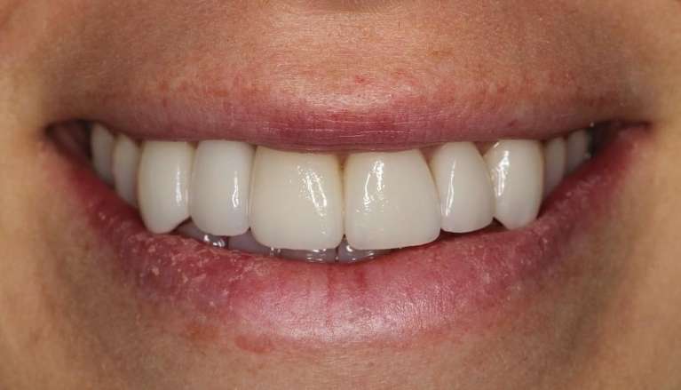 porcelain veneers and crowns used to reshape this patient's front teeth