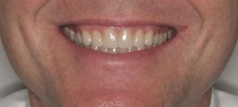 man's new smile after crowns and veneers, tuscaloosa al