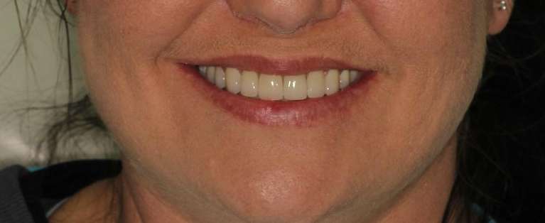 porcelain crowns used to repair stained and worn teeth