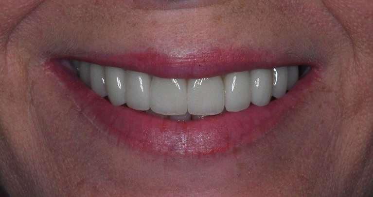 Womens mouth after porcelain crowns, tuscaloosa al