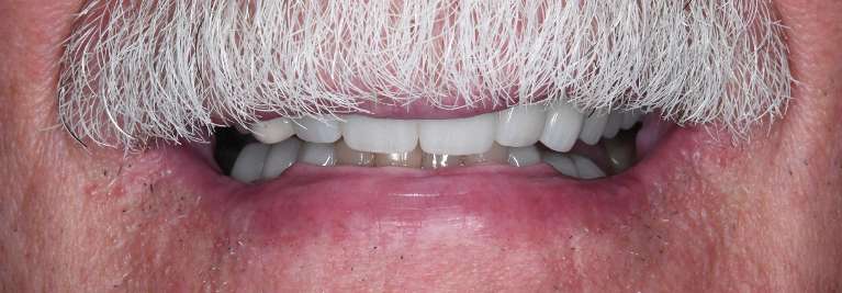 Close up of mans mouth with mustache after porcelain crowns, tuscaloosa al