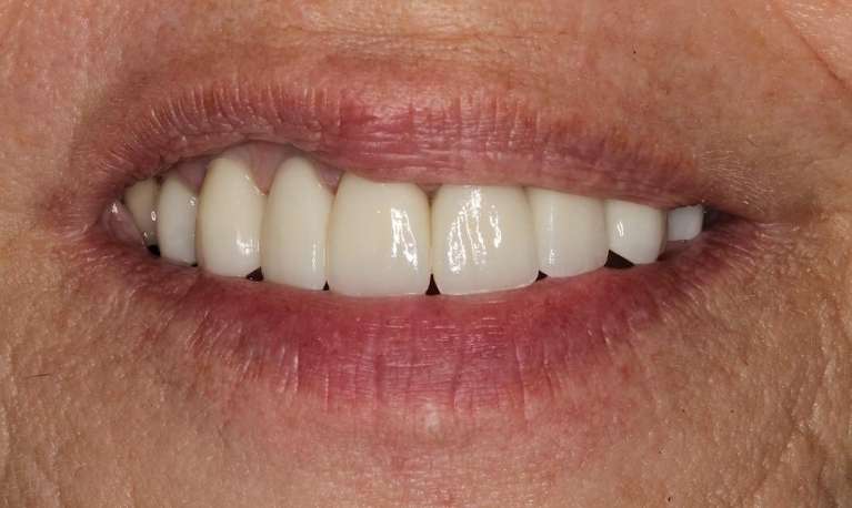 porcelain crowns used to repair discolored front teeth