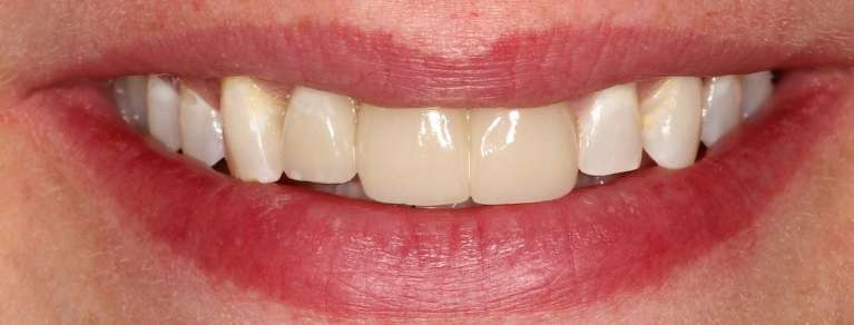 smile after using implants and crowns to fix broken teeth